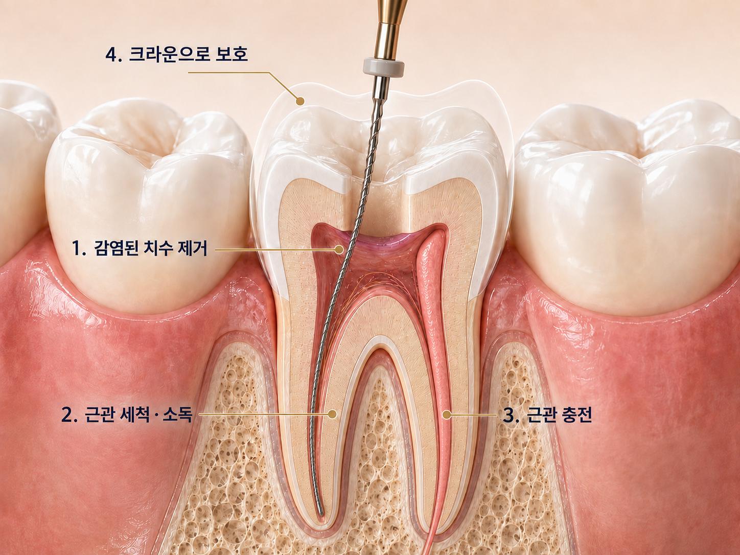 근관치료신경치료